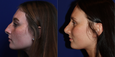 Rhinoplasty before and after photo