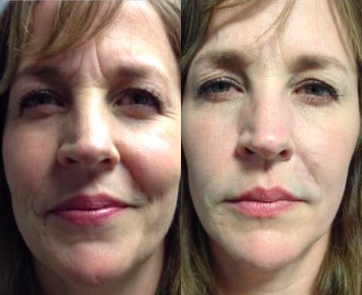 Botox before and after photo