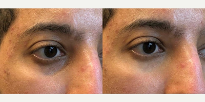 CO2 Laser before and after photo