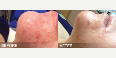 HydraFacial before and after photo