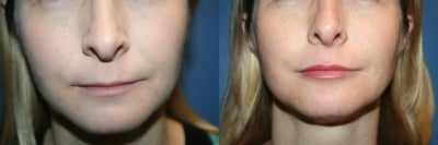 Lip Fillers before and after photo