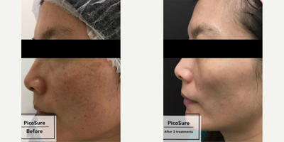 PicoSure before and after photo