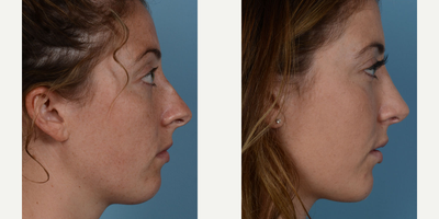 Rhinoplasty before and after photo