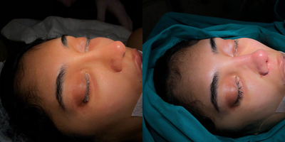 Rhinoplasty before and after photo
