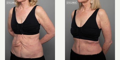Tummy Tuck before and after photo