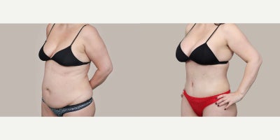 Tummy Tuck before and after photo