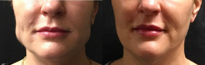 Botox for TMJ before and after photo