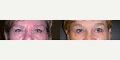 Botox before and after photo