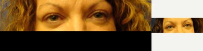 Eyelid Surgery before and after photo