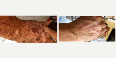 IPL before and after photo