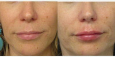 Lip Fillers before and after photo