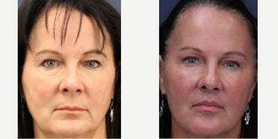 Lip Lift before and after photo