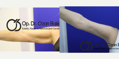 Arm Lift before and after photo