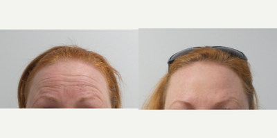Botox before and after photo