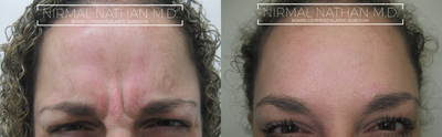 Botox before and after photo