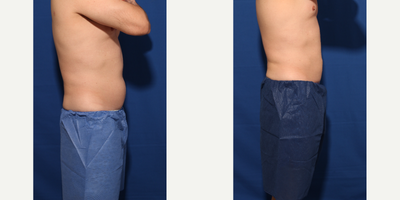 CoolSculpting before and after photo