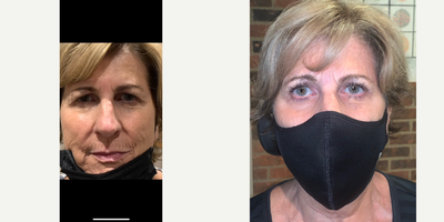 Double Eyelid Surgery before and after photo