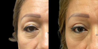 Eyelid Surgery before and after photo