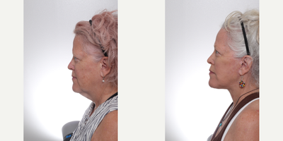 Facelift before and after photo