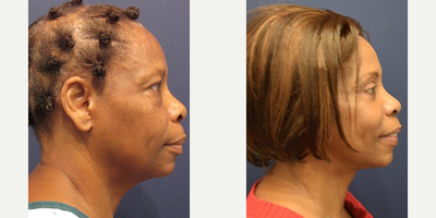 Facelift before and after photo