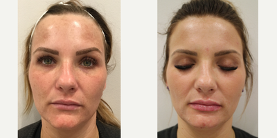 Halo Laser before and after photo