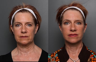 Facelift before and after photo