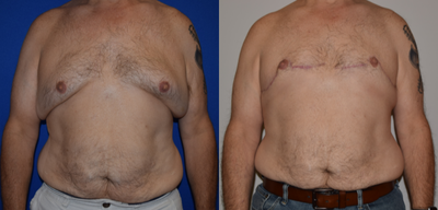 Gynecomastia Surgery before and after photo