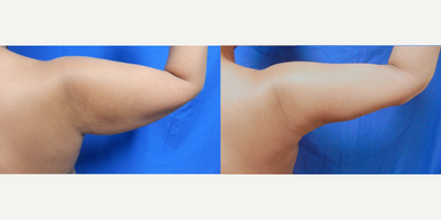 Vaser Liposuction before and after photo