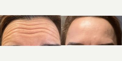Botox before and after photo