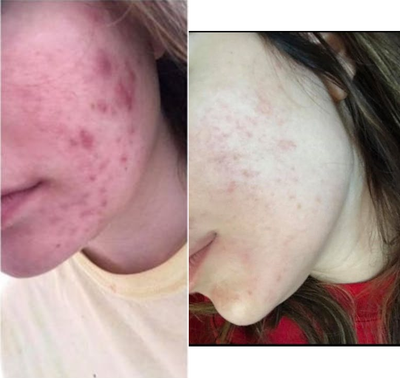 Chemical Peel before and after photo