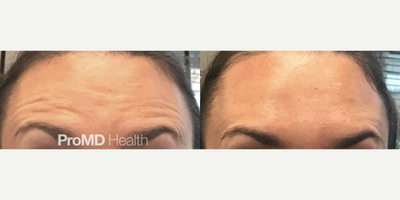 Dysport before and after photo