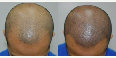 Scalp Micropigmentation before and after photo
