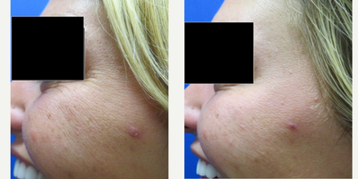 Botox before and after photo