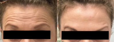 Botox before and after photo