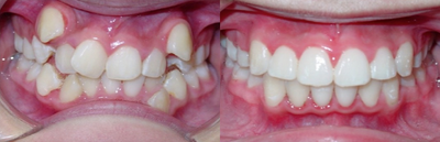Braces before and after photo