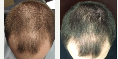 PRP for Hair Loss before and after photo