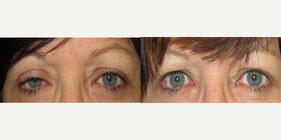 Ptosis Surgery before and after photo