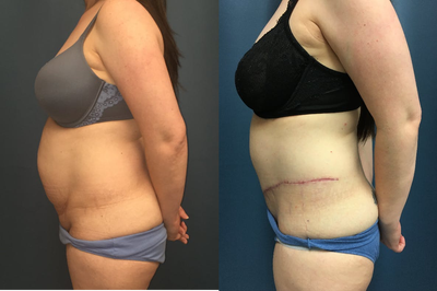 Tummy Tuck before and after photo