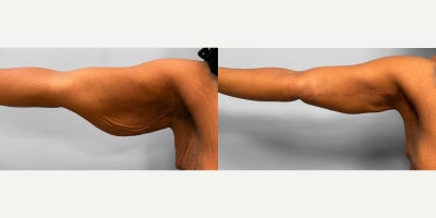 Arm Lift before and after photo