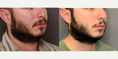 Beard Transplant before and after photo
