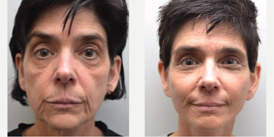 Facelift before and after photo