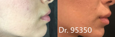 Juvederm before and after photo