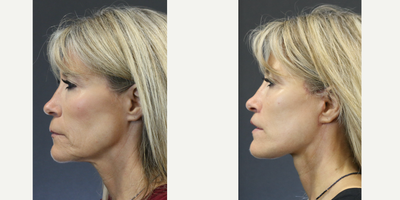 Lip Lift before and after photo
