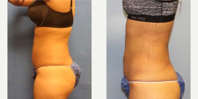 Liposuction before and after photo