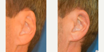 Ear Surgery before and after photo