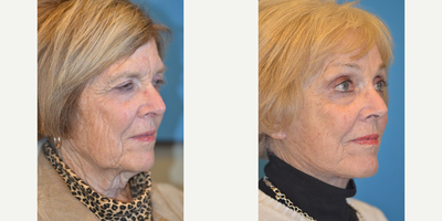 Lower Facelift before and after photo