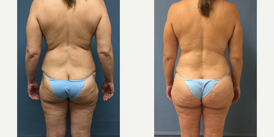 Brazilian Butt Lift before and after photo