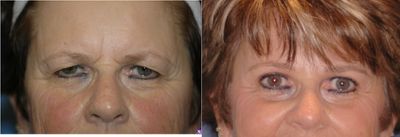 Brow Lift before and after photo