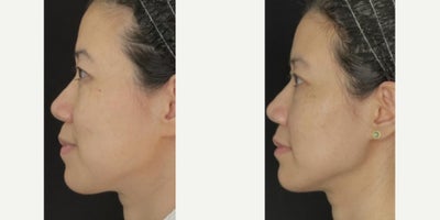 Chin Filler before and after photo