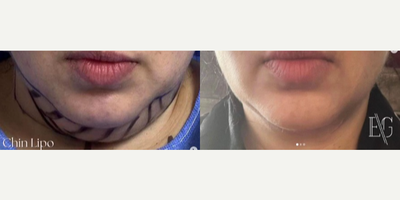Chin Liposuction before and after photo